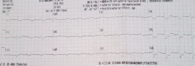 Obr. 1  Vstupn EKG kivka posdky RLP