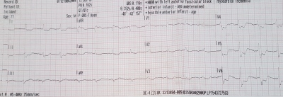 Obr. 1 � Vstupn� EKG k�ivka pos�dky RLP