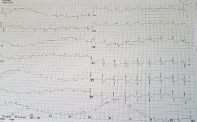 Obr. 2  Vstupn EKG kivka pi pjmu na JIP