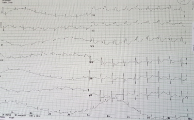Obr. 2 � Vstupn� EKG k�ivka p�i p��jmu na JIP