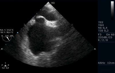 Obr. 7  Zobrazen aneurysmatu sovho septa v obraze jcnov echokardiografie