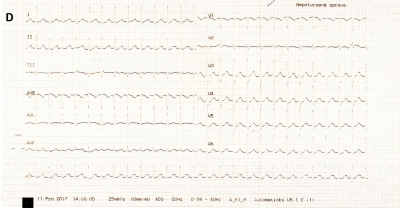 Obr. 1 � (A, C) Na EKG proveden�m RZS byla inici�ln� registrov�na setrval� �zkokomplexov� tachykardie s frekvenc� 220/min s nespecifick�mi zm�nami ve smyslu difuzn�ch depres� �seku ST a elevace v aVR. (B) Po intraven�zn� aplikaci 150 mg amiodaronu RZS byla na EKG z�ejm� fibrilace s�n� s komorovou odpov�d� okolo 150/min s �stupem ischemick�ch zm�n. (D) Na na�em pracovi�ti byla na vstupn�m EKG pravideln� �zkokomplexov� tachykardie s frekvenc� 156/min.