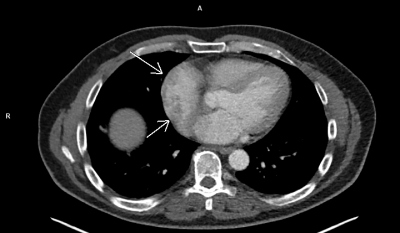 Obr. 3 � PET/CT vy�et�en� (transverz�ln� a front�ln� projekce) prokazuje hypermetabolismus gluk�zy (= zv��en� metabolick� aktivita), kter� se prom�t� do nepravideln�ch �tvar� prominuj�c�ch ze st�ny prav� s�n� intralumin�ln� (�ipky). Pozn.: difuzn� zv��en� metabolick� aktivita se �asto fyziologicky zobrazuje v myokardu lev� komory srde�n� (co� je patrn� i u tohoto pacienta), tenk� myokard pravostrann�ch srde�n�ch odd�l� fyziologicky m� m�t n�zkou metabolickou aktivitu. Sn�mky laskav� poskytlo Odd�len� nukle�rn� medic�ny � PET centrum Nemocnice Na Homolce