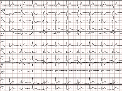 Obr. 1  Vstupn EKG