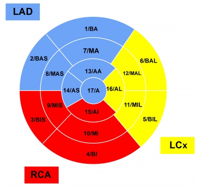 Obr. 4  Sedmnctisegmentov model AHA  koronrn zsoben (Bulls eye): LAD  modr odpovd RIA, RCA  erven ACD a LCx  lut RC. Segmenty: 1/BA  bazln anteriorn, 2/BAS  bazln anteroseptln, 3/BIS  bazln inferoseptln, 4/BI  bazln inferiorn, 5/BIL  bazln inferolaterln, 6/BAL  bazln anterolaterln, 7/MA  stedn anteriorn, 8/MAS  stedn anteroseptln, 9/MIS  stedn inferoseptln, 10/MI  stedn inferiorn, 11/MIL  stedn inferolaterln, 12/MAL  stedn anterolaterln, 13/AA  apikln anteriorn, 14/AS  apikln septln, 15/AI  apikln inferiorn, 16/AL  apikln laterln, 17/A  apex. (Vytvoeno pro ely tohoto lnku Martou pikovou, dokumenttorkou FN Brno.)