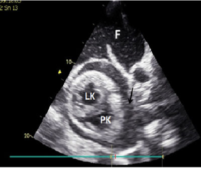 Obr. 2 � Transtorak�ln� echokardiografie. Perikardi�ln� v�potek, bez zn�mek tampon�dy (ozna�en �ipkou). F � fluidotorax; LK � lev� komora; PK � prav� komora. 