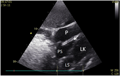 Obr. 4 � Transtorak�ln� echokardiografie. Perikardi�ln� v�potek se zn�mkami tampon�dy, utla�en� PK ozna�ena �ipkou. LK � lev� komora; LS � lev� s��; P � perikardi�ln� v�potek; PS � prav� s��.