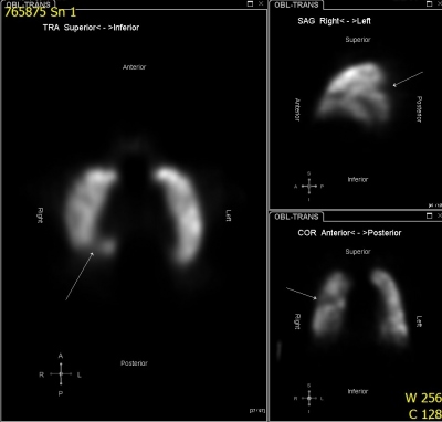 Obr. 8  Perfuzn scintigrafie plic na gama kamee v kombinaci s metodou SPECT s nslednou rekonstrukc obrazu v rovin transverzln, sagitln a koronln
