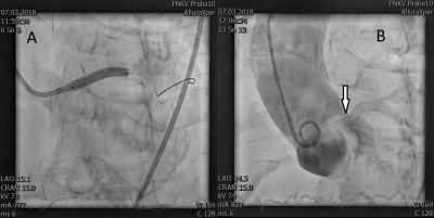 Obr. 5 � Implantace kovov�ho stentu do kmene lev� koron�rn� tepny (ACS) s jeho prominenc� do aorty. (A) Rozta�en� stentu v kmeni ACS. (B) Fin�ln� v�sledek po perkut�nn� koron�rn� intervenci. 
