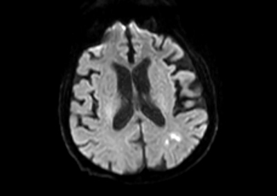 Obr. 3  Magnetick rezonance mozku s drobnm ischemickm loiskem parietookcipitln vlevo (embolizan etiologie)