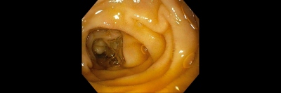 Obr. 1 – Gastrofibroskopie v oblasti duodena – fyziologický nález, bez atrofie sliznice