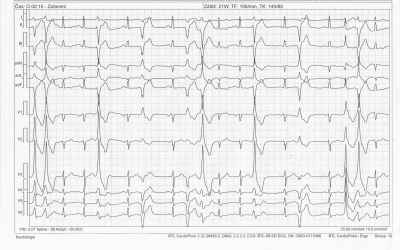 Obr. 1  EKG zznam z ergometrie. Adrenergn zvislost KES s obrazem bidireknch kuplet je diagnostickou znmkou pro CPVT.