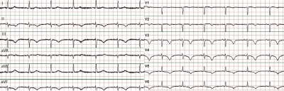 Obr. 1  EKG s inverz vln T ve svodech V1V6, II, III, aVF a prodlouen interval QT