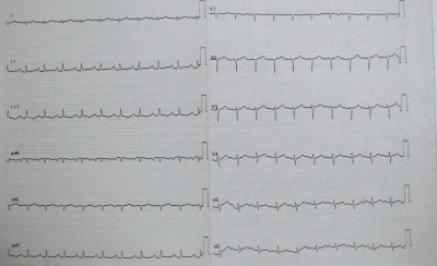 Obr. 6  EKG z pedel hospitalizace pro perikardiln vpotek
