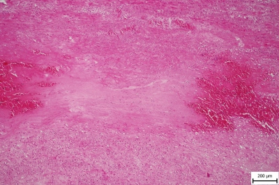 Fig. 1 � (A) Aortic wall with hemorrhage among the laminar layers of the media and smooth muscle disorganization (HE stain). 