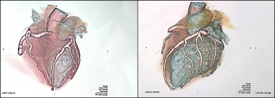 Fig. 2 � CT coronary angiography of the patient K., 29 y.o.