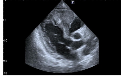 Obr. 2 � Echokardiografie � modifikovan� parastern�ln� projekce na dlouhou osu (PLAX), tumor