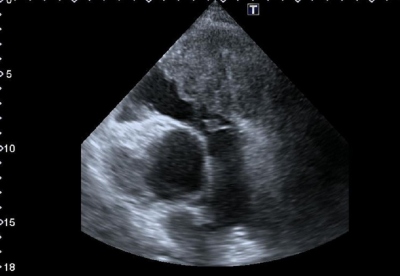 Obr. 3 � Echokardiografie � parastern�ln� projekce na kr�tkou osu (PSAX), v�tokov� trakt prav� komory (RVOT), tumor