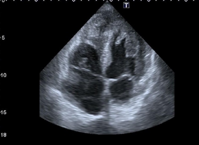 Obr. 4 � Echokardiografie � apik�ln� �ty�dutinov� projekce (A4C), tumor 