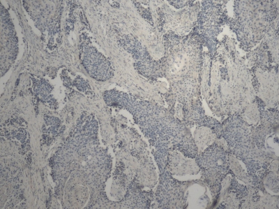 Obr. 7 � Imunohistochemie � cytokeratin 7 (CK7�)