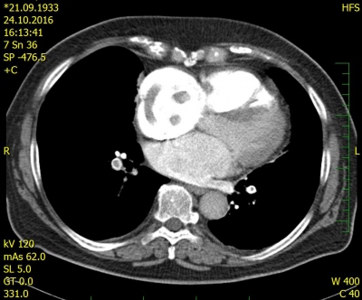 Obr. 1 � CT angiografie plicnice, diagnostika pomoc� p��m� vizualizace embolu zobrazen� jako defekty kontrastn� n�pln� lumen