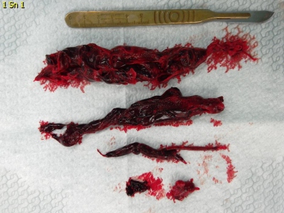 Obr. 3 � Postopera�n� chirurgick� n�lez po extrakci masivn�ch tromb� z arteria pulmonalis a prav� s�n�