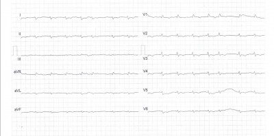 Obr. 5b – Srovnání EKG v úvodu zdravotních obtíží (křivka A) a při diagnóze CP (křivka B). Vidíme nespecifické změny jako sníženou voltáž komplexů QRS a oploštění a inverzi vln T.