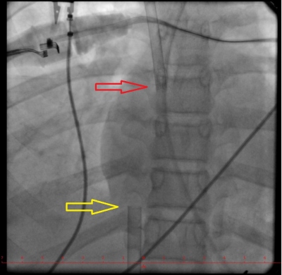 Obr. 9 – Skiaskopie – správná poloha kanyl ECMO v pravé síni, červená šipka – 17F kanyla z vena jugularis l. dx, žlutá šipka – 20F kanyla z vena femoralis l. dx