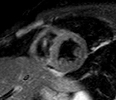 Obr. 14 – Magnetická rezonance srdce, normální nález, bez infiltrace myokardu