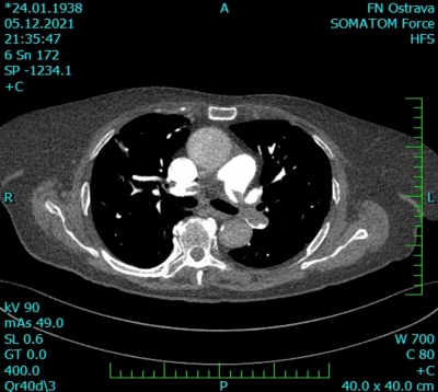 Obr. 3 – CT angiografie plicnice, transverzální řez – emboly v plicnici bilaterálně