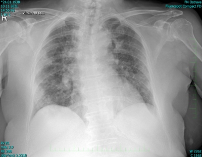 Obr. 1 – Rtg snímek plic, zánětlivé infiltrace v plicním parenchymu bilateralně