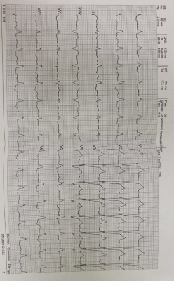Obr. 1 – EKG 42letého pacienta s DKMP – sinusový rytmus s šíří komplexu QRS 140 ms při blokádě levého Tawarova raménka