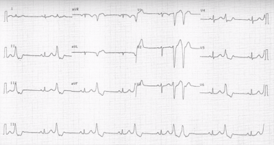 Obr. 2  EKG s etnou komorovou extrasystoli  bigeminicky vzan KES, 1 kuplet